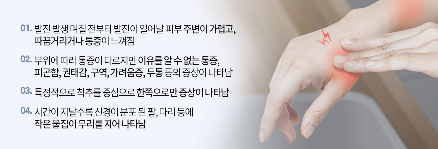 대상포진의 증상